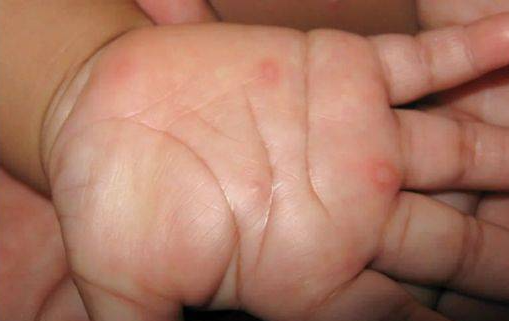 수족구 손 증상