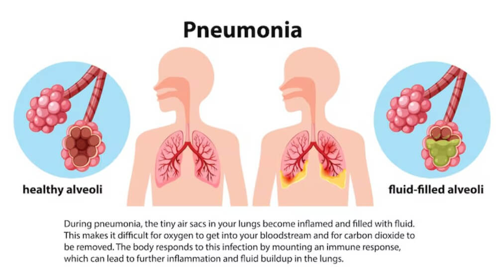 갑상선암을 설명하는 분석 자료
