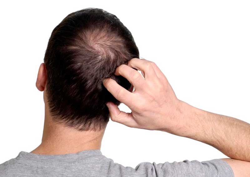 쏘팔메토 효능 탈모 예방