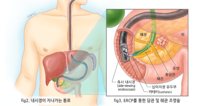 췌장사진