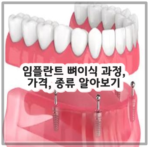 임플란트 뼈이식 과정, 가격, 종류 알아보기