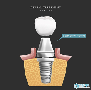 무절개 임플란트