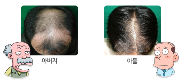 탈모 증세-아버지와 아들