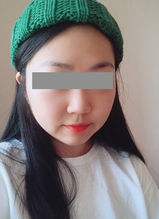 턱살지방흡입 후기