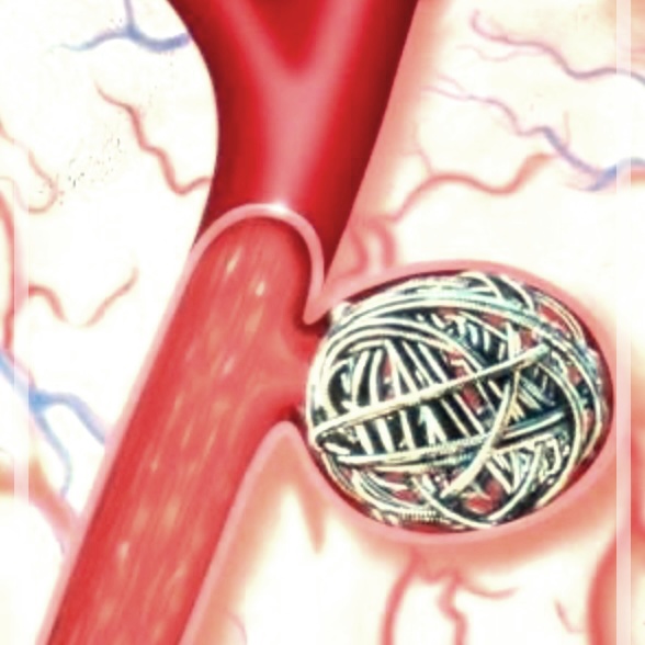 뇌동맥류 코일 색전술 비용 및 수술후기.