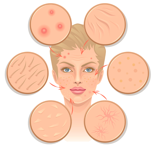 이마 두피,여드름 원인 분석 후 관리 방법