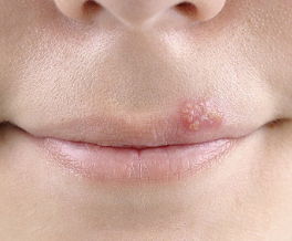 아시클로버 연고 효능