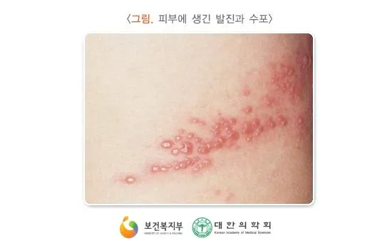 대상포진 치료방법에 대한 총정리 건강 질병관리_4