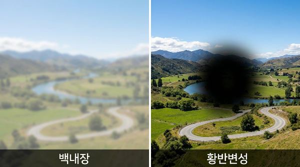 백내장과 황반변성 총정리