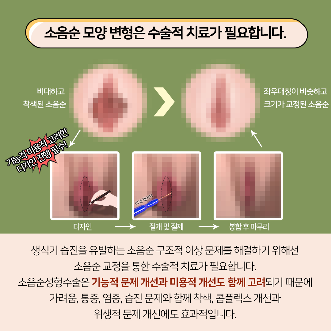 소음순 모양은 수술적 치료가 필요!