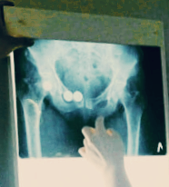 고관절통증 증상과 원인