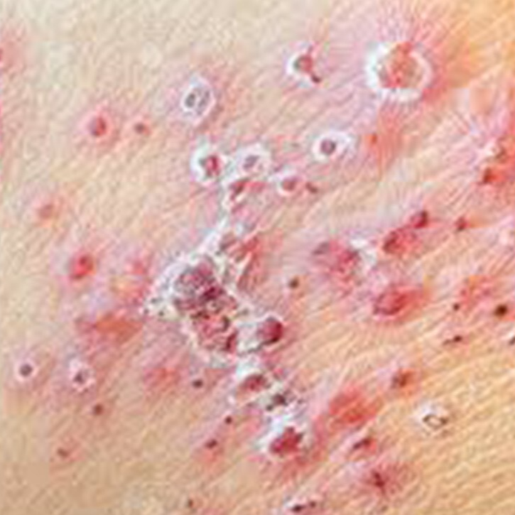 대상포진 초기 증상 예방접종 치료