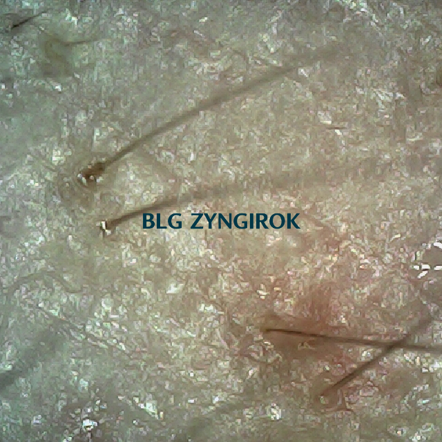 피나모아 복용 25주차 오른쪽 M자 부분 두피 사진 모습이다.