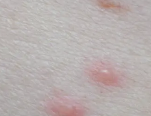 간경화 초기증상 29