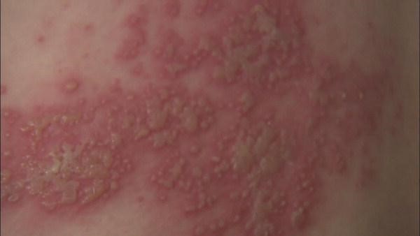 대상포진 발진단계