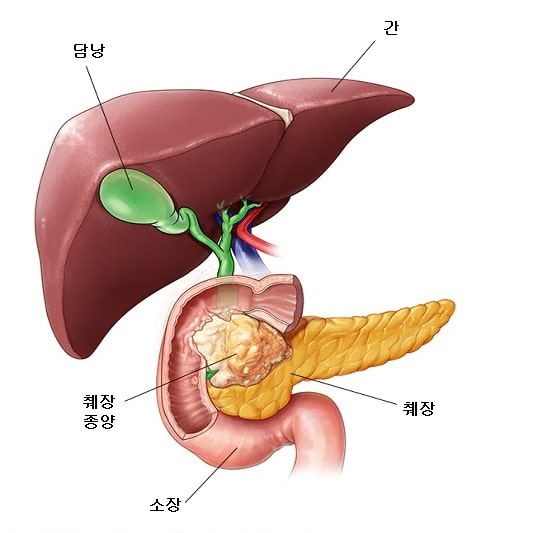 췌장암 증상