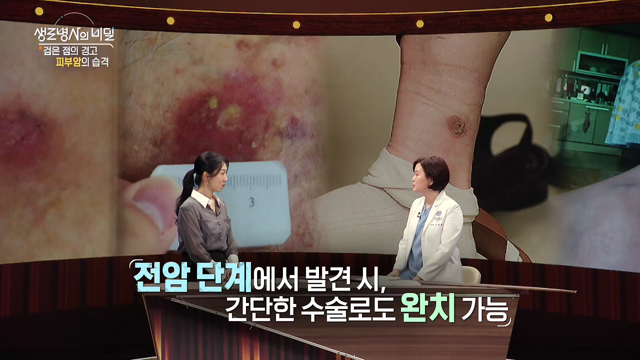 생로병사의 비밀 피부암 검은점