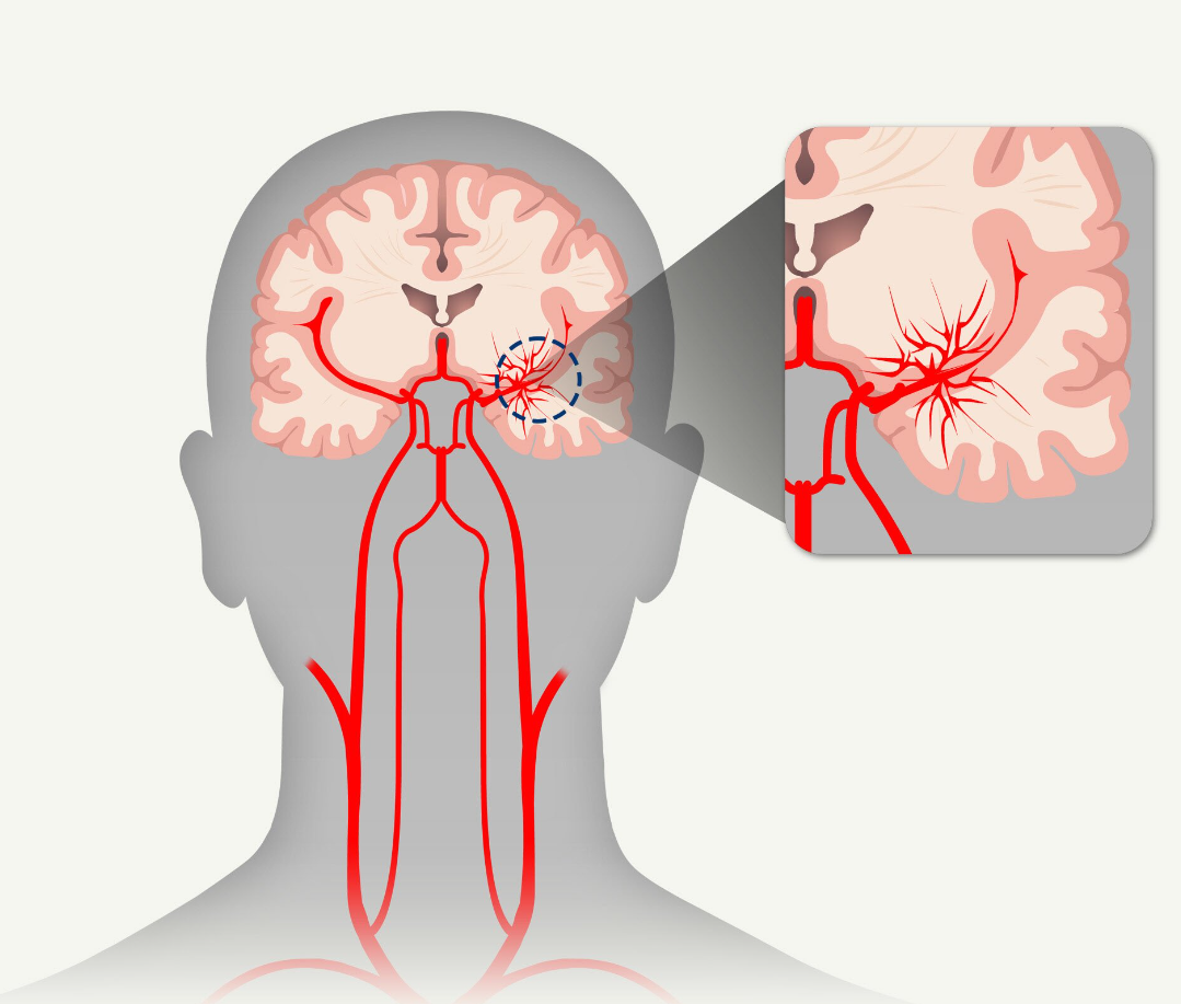 모야모야병 증상 원인 주의사항 치료