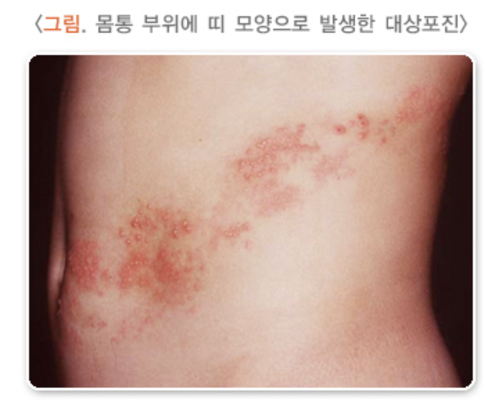 몸통부위에 나타난 대상포진