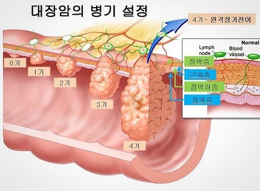 대장암의 병기 설정 이미지