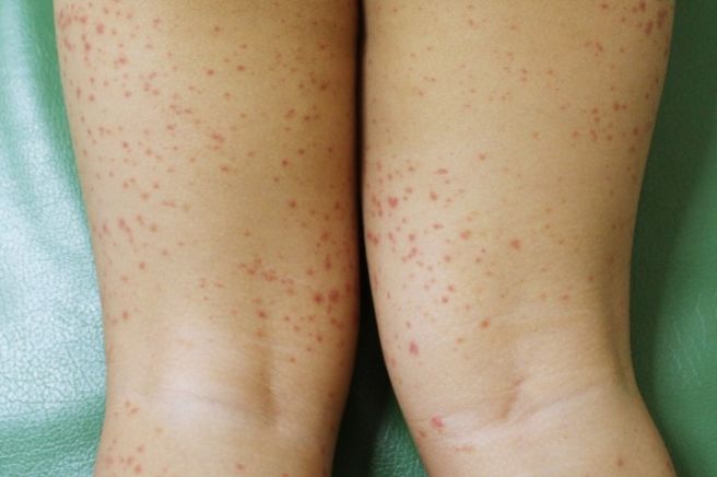 자반증 초기증상