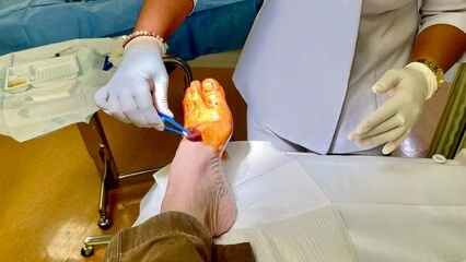 내성발톱 자가치료 에서도 가능한 실질적인 방법들을 알아봤습니다. 내성발톱 자가치료&#44; 고통 없이 집에서 해결할 수 있는 방법이 궁금하신가요? 발톱이 피부 속으로 파고드는 불편함에서 벗어나고 싶다면&#44; 이제부터 제가 알려드릴 몇 가지 간단하지만 효과적인 자가치료 방법들에 주목해 보세요.