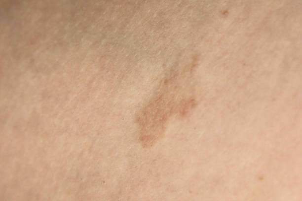 장미색 비강진 원인, 치료, 재발 등에 대해 알아봤습니다. 장미색 비강진은 pityriasis rosea이라고 불리는데요. 어떤 증상과 원인 치료가 있는지 꼼꼼히 읽어보세요!