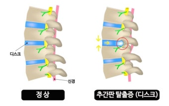 정상 허리디스크비교