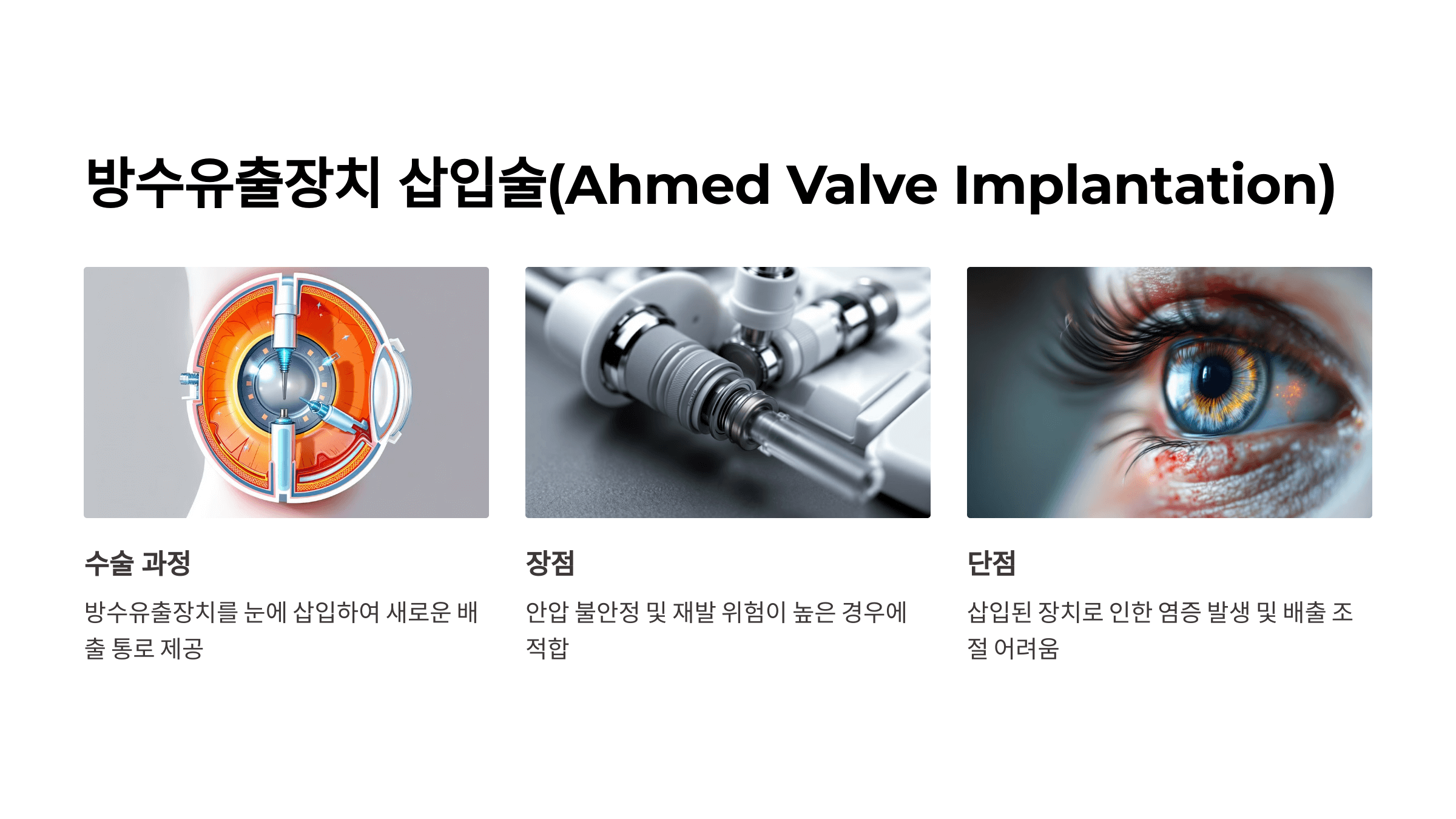 녹내장과 관련된 사진입니다.