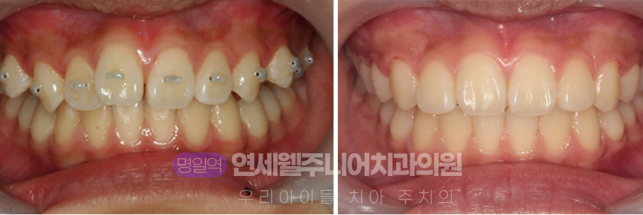 중학생 MTA 미니튜브 교정 전후 앞니 돌출과 치열 배열 변화를 비교한 정면 사진