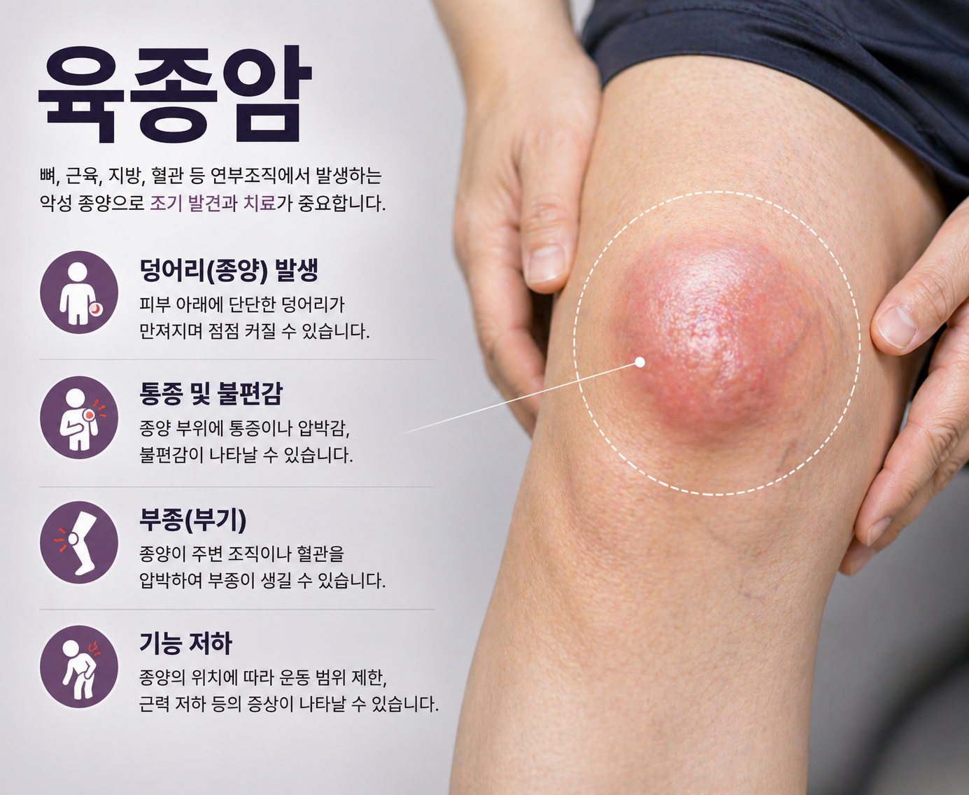 육종암 증상.원인.치료