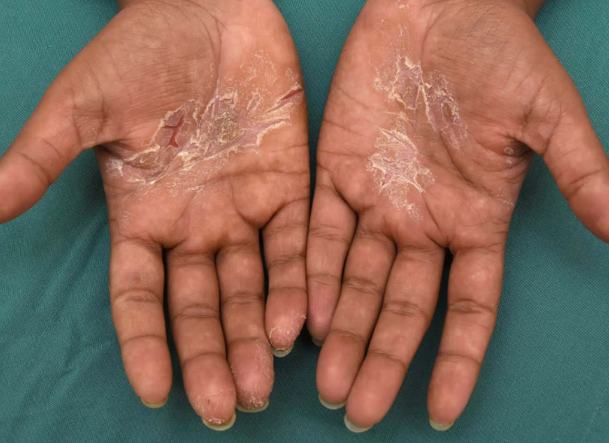 손바닥 껍질이 벗겨지는 이유
