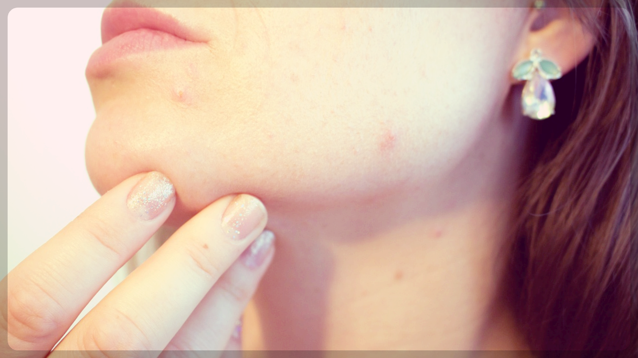 여성 얼굴 피부트러블 여드름