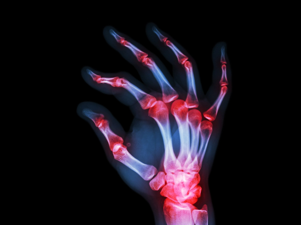 심한 손가락 관절염