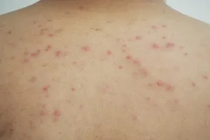 두드러기-원인