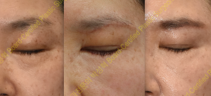 눈썹하거상-쌍꺼풀