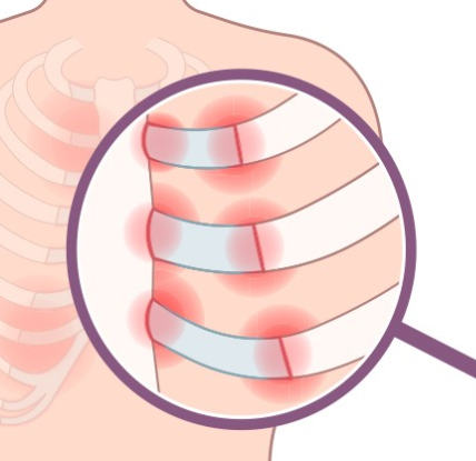 갈비뼈 금간 증상 1