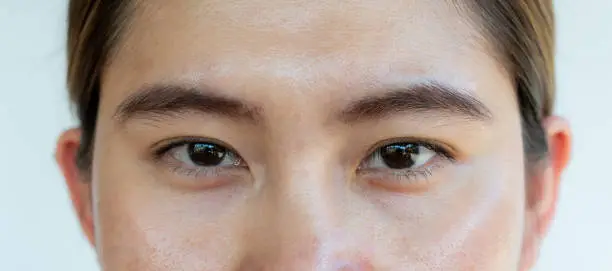 눈밑 주름 없애는 수술 비용