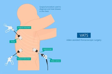 폐결절 원인 및 증상을 알아봤습니다. 폐결절이라는 말은 좀 생소한데요. 물론 폐결절 모두가 암으로 변하진 않지만 마땅한 전조증상이 없기 때문에 더욱 질병에 대해 숙지해야 합니다.
