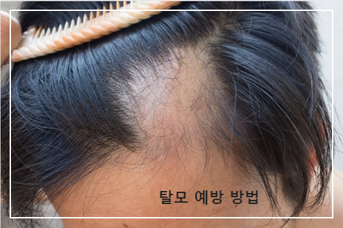 탈모 예방 방법 알아보고 예방