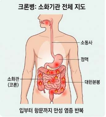 크론병