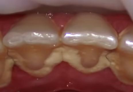 이빨 치석 쌓인 모습