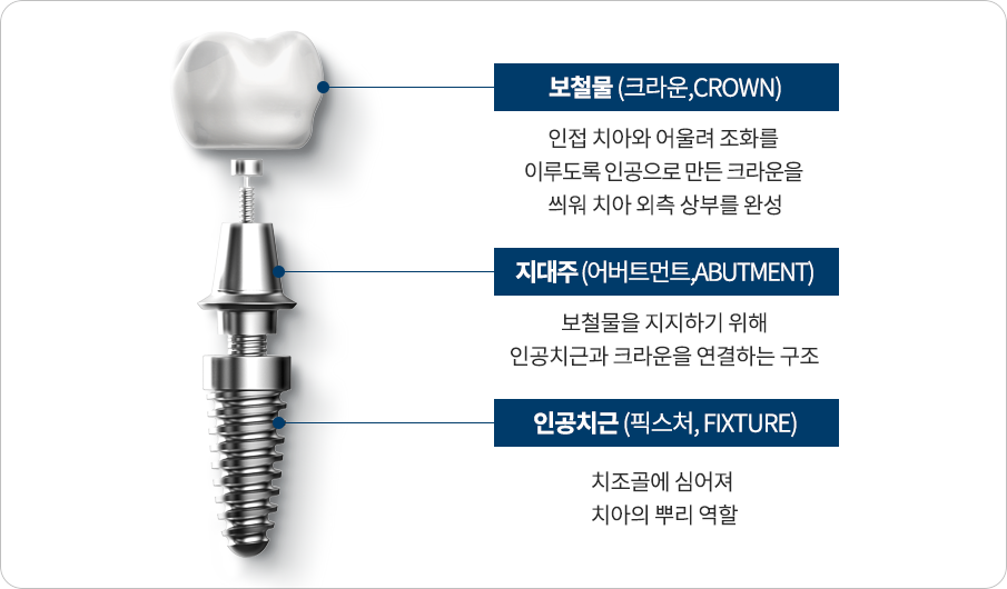 임플란트 구조 차이