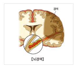뇌경색 뇌사진
