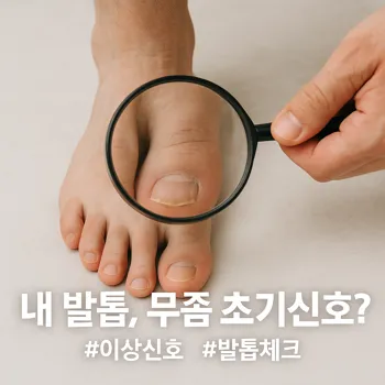 한 사람이 자신의 발을 내려다보며 돋보기로 엄지발톱을 자세히 들여다보는 모습. 돋보기로 확대된 엄지발톱에는 가장자리가 살짝 노랗게 변하고 표면에 미세한 흰색 점이 보이는 등, 발톱무좀의 미묘한 초기 증상이 나타나 있음. 밝고 깨끗한 배경에 발과 돋보기에 초점이 맞춰져 있고, 보는 사람의 궁금증을 자아내는 구도의 고화질 실사 사진.