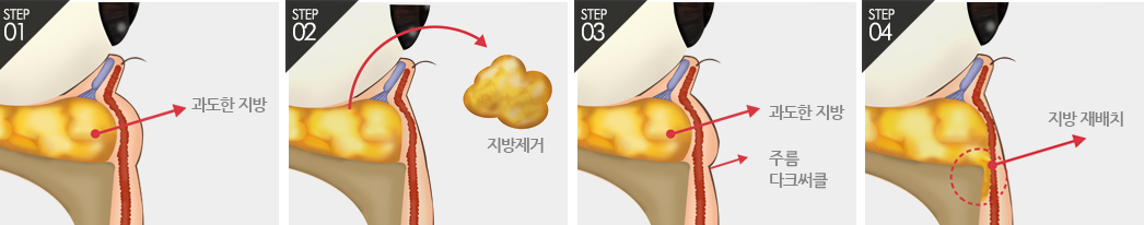 하안검-치료방법