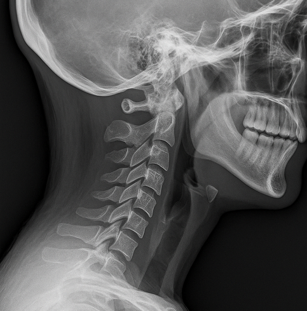 이 증상이 목디스크? 직장인이라면 필독, 자가진단 가이드!