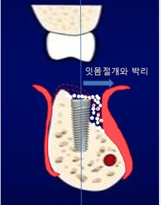 무절개 임플란트