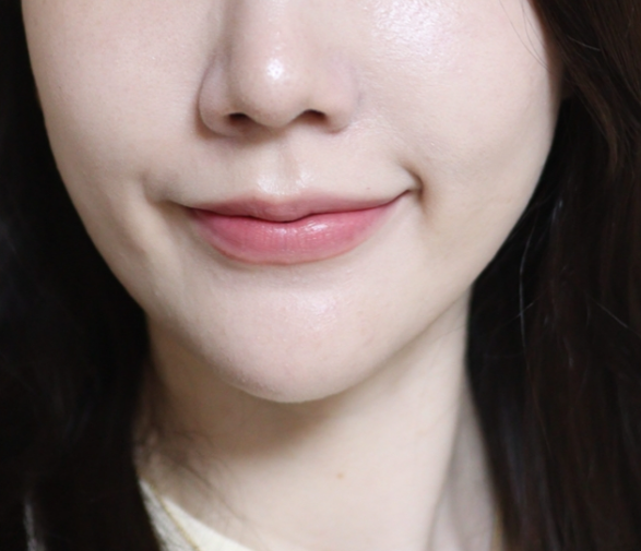 스킨보톡스 후기