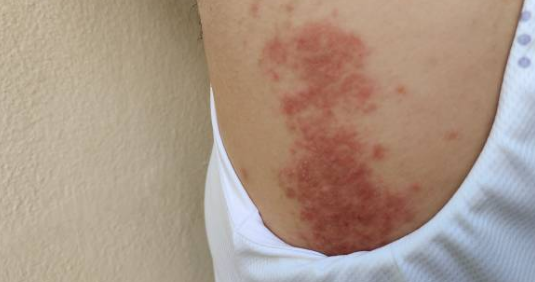 대상포진 증상&amp;#44; 전염&amp;#44; 치료방법 총정리 (2024ver)